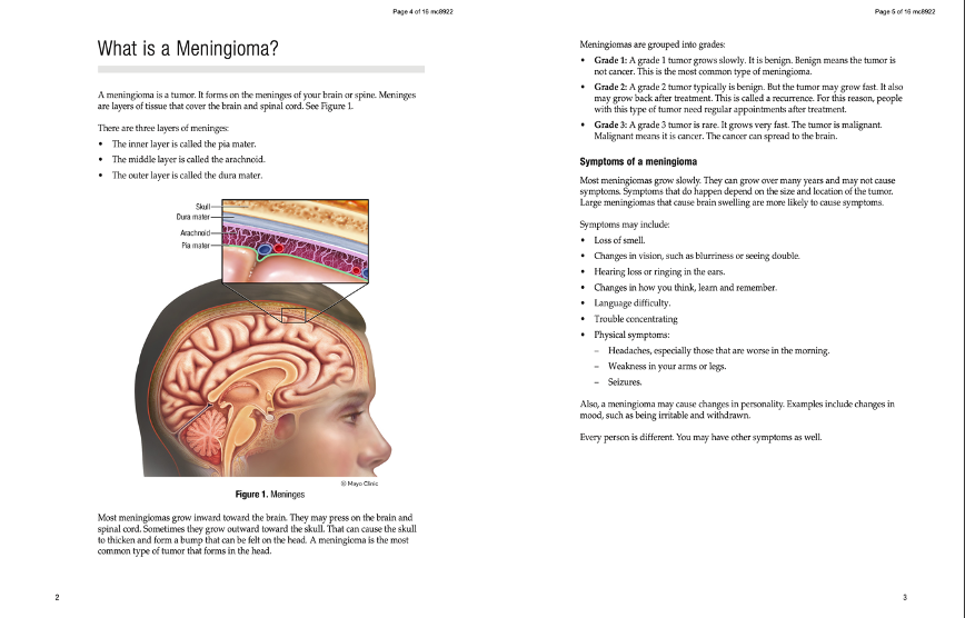 Meningioma